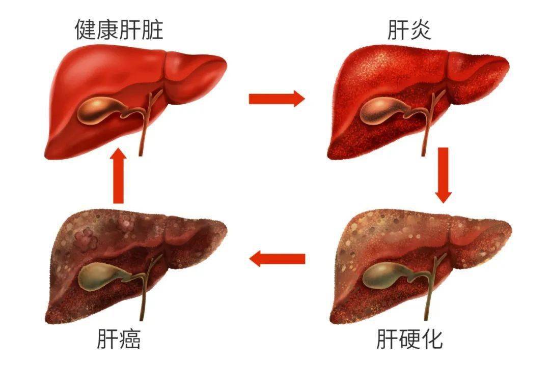 肝硬化最新治疗方法，小巷深处的治愈秘密探索