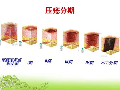 最新压疮分期详解与小巷深处的特色小店探秘