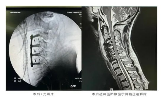脊髓损伤最新突破，科技重塑生活，璀璨突破展现科技力量
